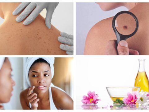 10 Natural Remedies to Clear Melanoma Feature 1