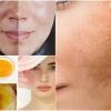 Homemade Remedies For Melasma