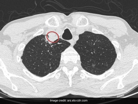 daej66no the patients ct scan revealed that a right paratracheal abscess existed 625x300 31 March 23